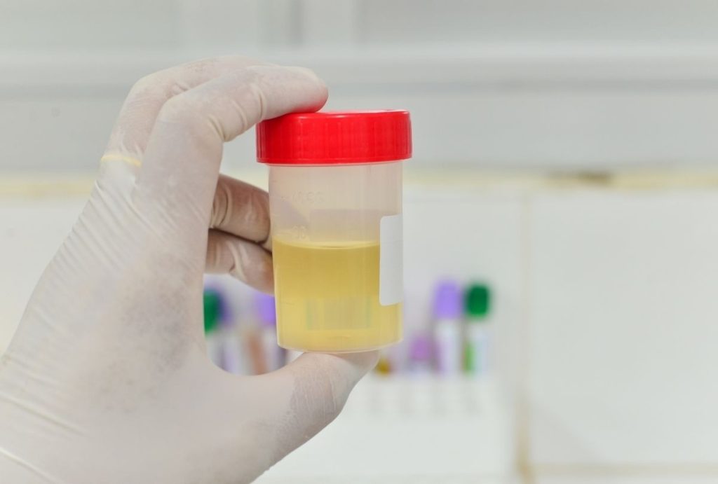 Gloved hand holding urine sample for lab testing during immigration medical exam same day appointment Houston clinic visit.